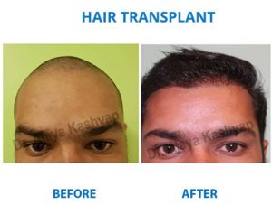 Hair Transplant surgery in india